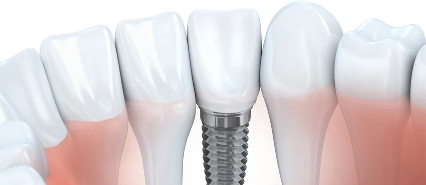 Implant